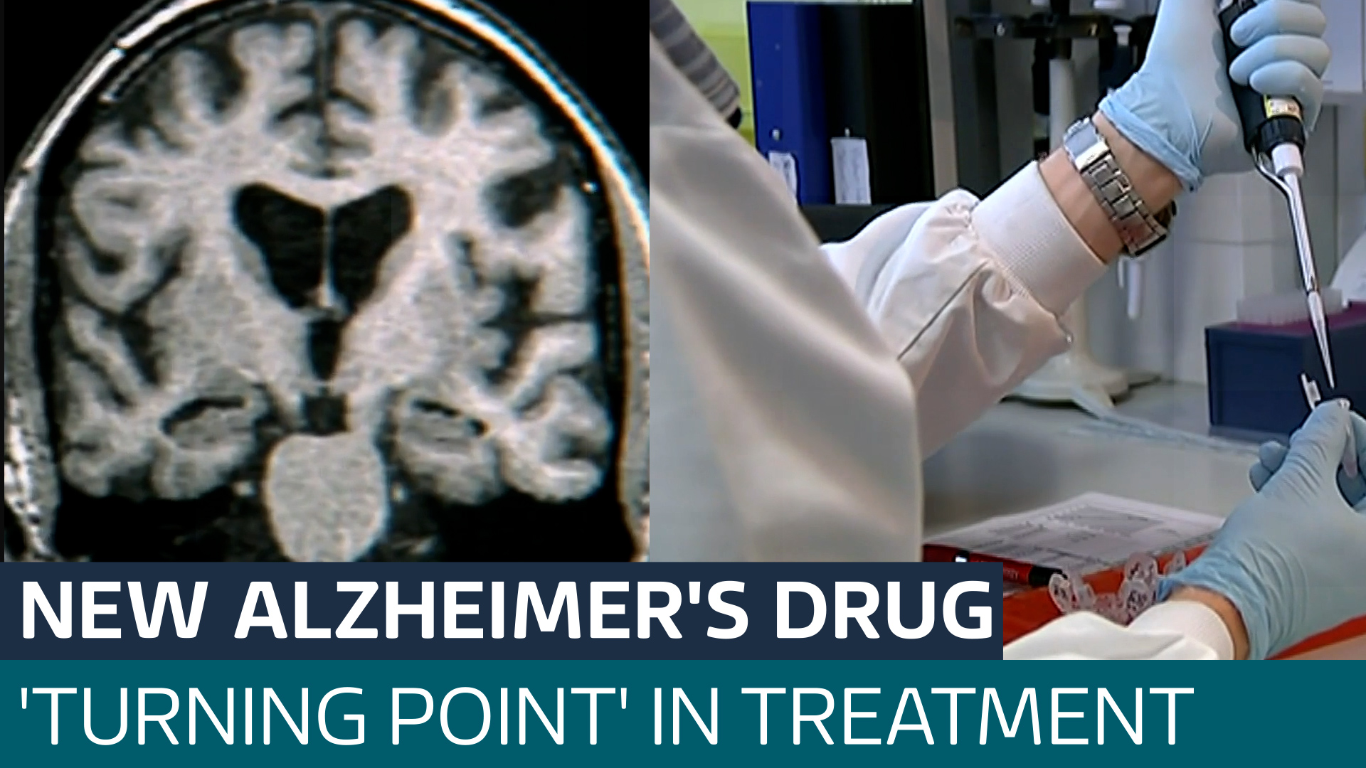 New Alzheimers Drug Found To Slow Progress Of Disease By 35 Latest From Itv News