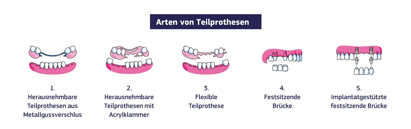 Eine Infografik mit verschiedenen Arten von Teilprothesen: Herausnehmbare Teilprothesen aus Metallgussverschluss, herausnehmbare Teilprothesen mit Acrylklammer, flexible Teilprothese, festsitzende Brücke, implantatgestützte festsitzende Brücke.