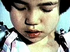 Photo of the first thalidomide-infected child to wear an electric prosthetic arm