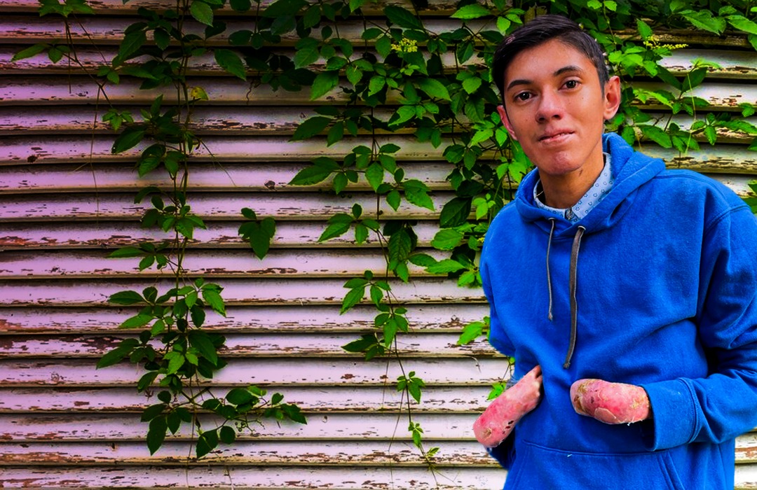 Fotografía de Martín, joven de 22 años, mostrando sus brazos afectados por la 'Piel de Mariposa'.