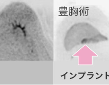 豊胸手術や乳がん手術後は乳がん検診を受けられない!?乳がんとの関係性を徹底解説(医師監修)