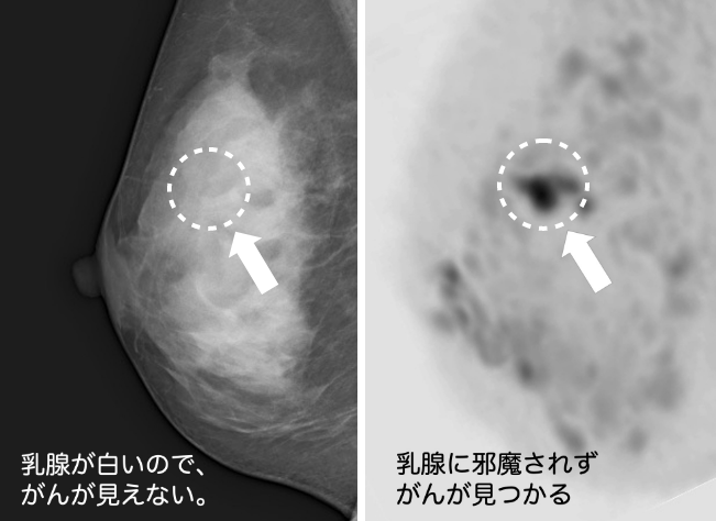 乳腺が多い人の特徴は？乳がん検診での注意点も紹介！ | 乳がん