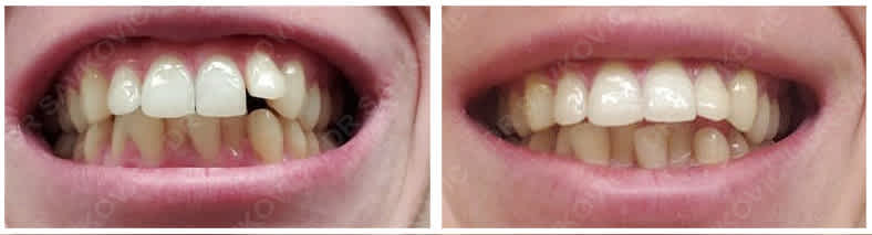 Pomeranje zuba folijama