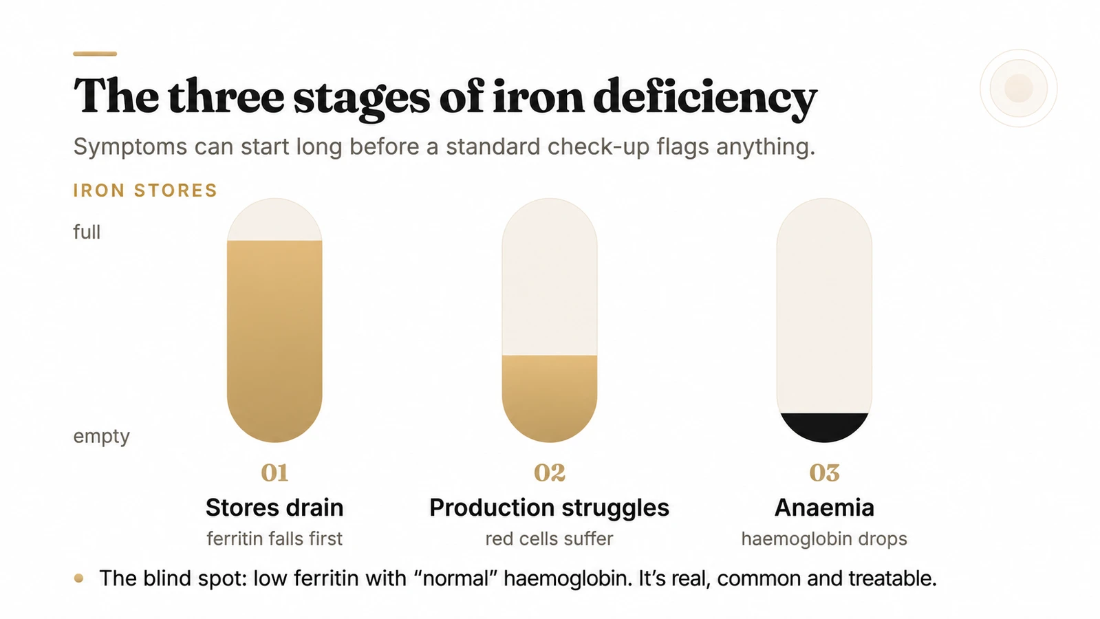The three stages of iron deficiency shown as draining iron stores: stores drain as ferritin falls first, red cell production struggles, then anaemia as haemoglobin drops.