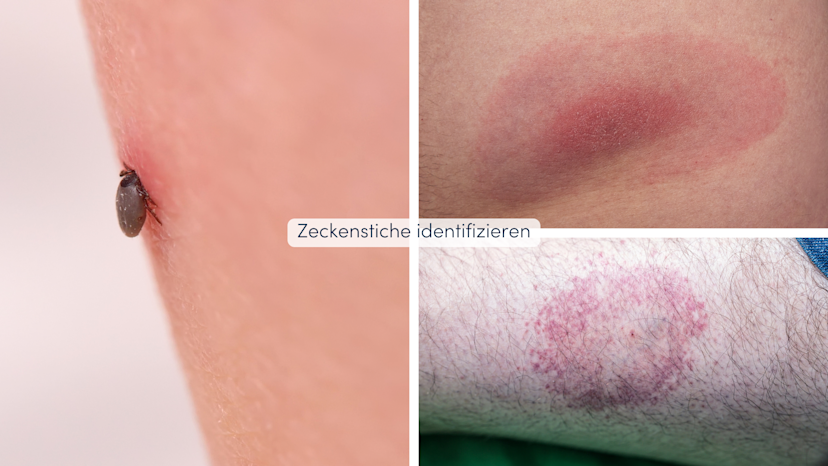 Wie Sieht Ein Verkapselter Insektenstich Aus Insektenstiche unterscheiden: Erkennungsmerkmale und Symptome