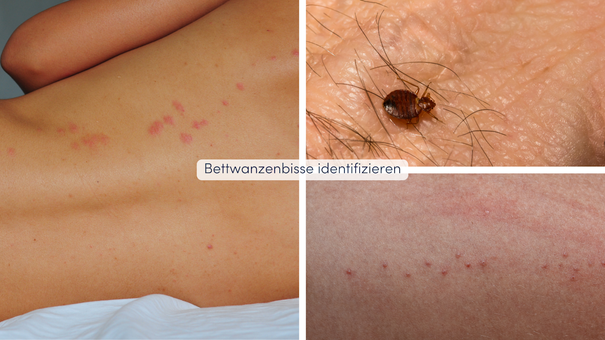 Insektenstiche unterscheiden Erkennungsmerkmale und Symptome