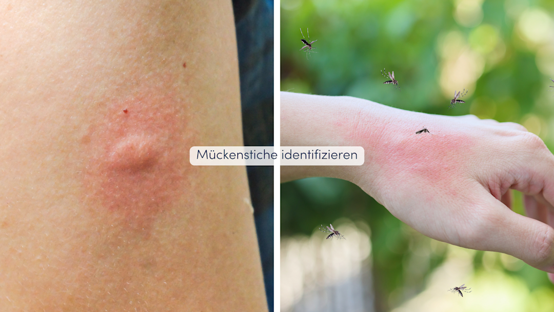 Wie Sieht Ein Verkapselter Insektenstich Aus Insektenstiche unterscheiden: Erkennungsmerkmale und Symptome
