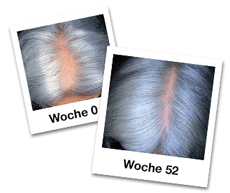 Haarausfall und Wechseljahre - Image 5 - Regaine - de-DE