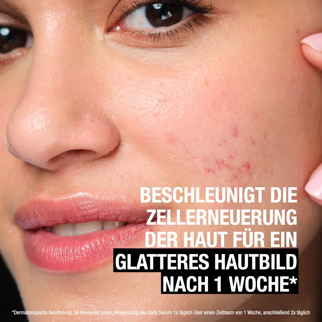 Neutrogena Anti-Pickel+ Liquid Exfoliant beschleunigt die Zellerneuerung der Haut für ein glatteres Hautbild nach einer Woche. Basierend auf einer dermatologischen Beurteilung, 34 Anwender:innen, Anwendung des Daily Serums einmal täglich über einen Zeitra