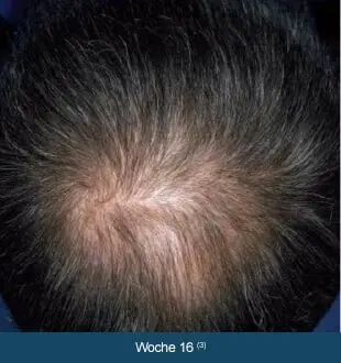 REGAINE® MÄNNER – Therapieverlauf nach 16 Wochen