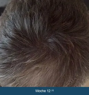 REGAINE® MÄNNER – Therapieverlauf nach 12 Wochen