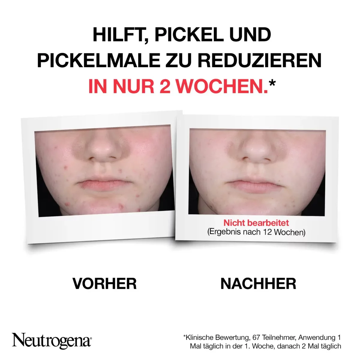 Hilft, Pickel und Pickelmale zu reduzieren in nur zwei Wochen. Klinische Bewertung, 67 Teilnehmer, Anwendung einmal täglich in der ersten  Woche, danach zwei Mal täglich