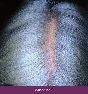 Regaine Frauen – Therapieverlauf nach 52 Wochen: Deutlich volleres, graues Haar.