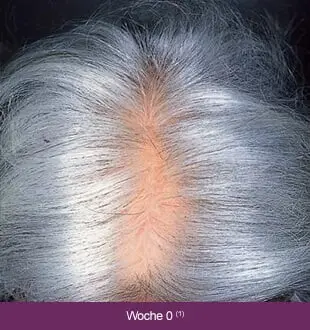 Regaine Frauen – Therapieverlauf nach 0 Wochen: Lichtes, graues Haar.