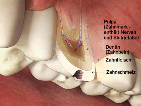 cavity2-img1