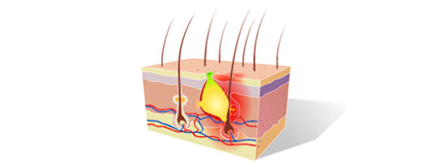 Was ist Akne? Wie kann man sie behandeln? - Image 6 - Neutrogena - de-DE