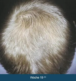 REGAINE® MÄNNER – Therapieverlauf nach 19 Wochen