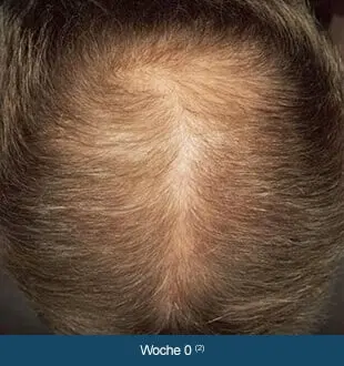 REGAINE® MÄNNER – Therapieverlauf nach 0 Wochen