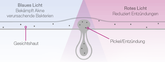 Was ist Akne? Wie kann man sie behandeln? - Image 5 - Neutrogena - de-DE