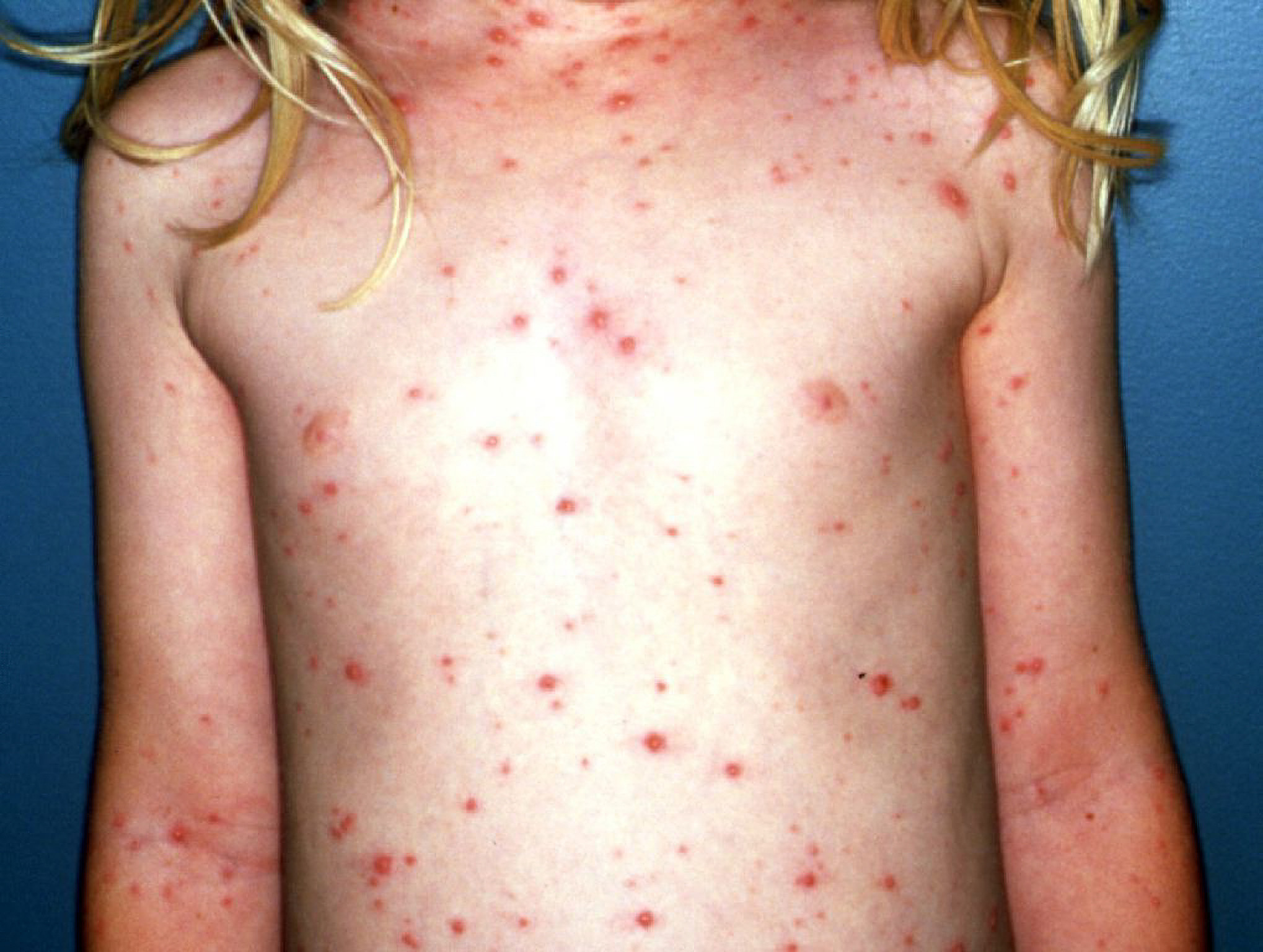 chicken pox rash pictures early stages
