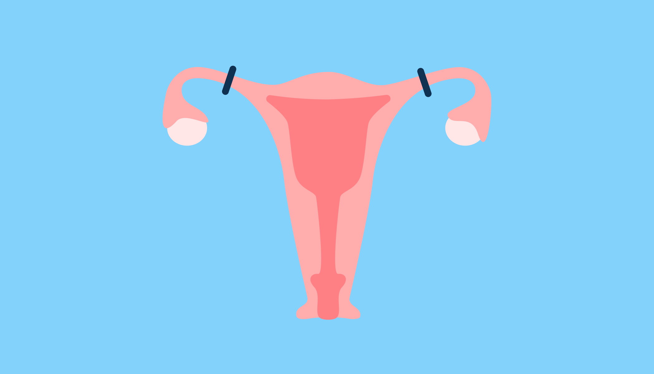 Ligature des trompes : tout savoir sur cette méthode contraceptive