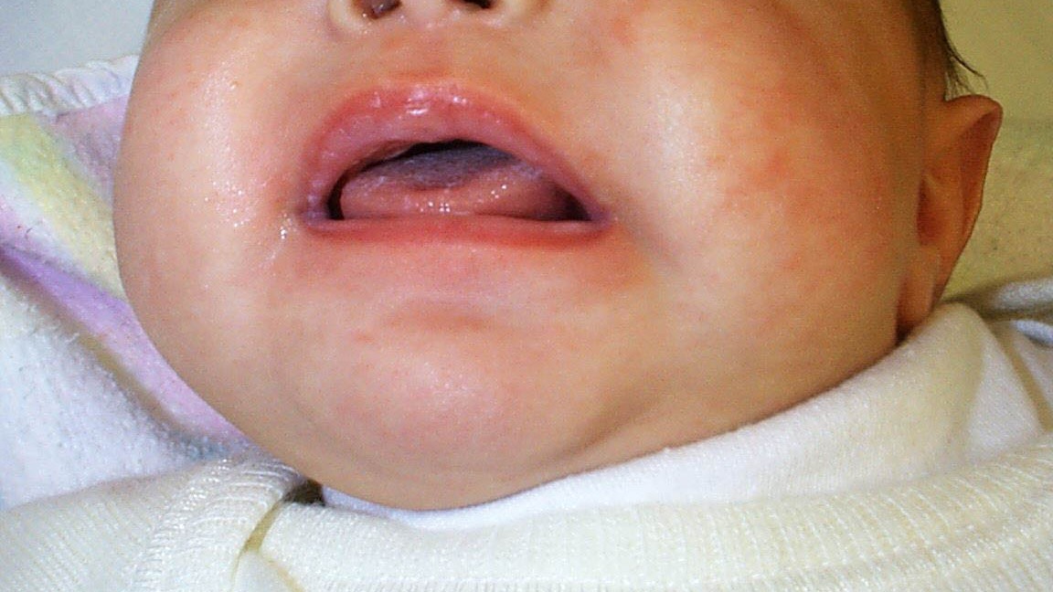 Bilde av baby med Candidiasis