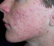 Folliculitis Face