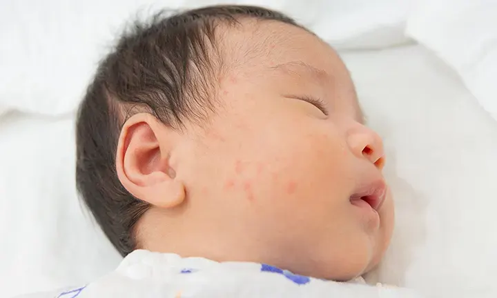 Banner Image of Baby with Hives for Article on Baby Hives: Symptoms, Causes, and Treatments
