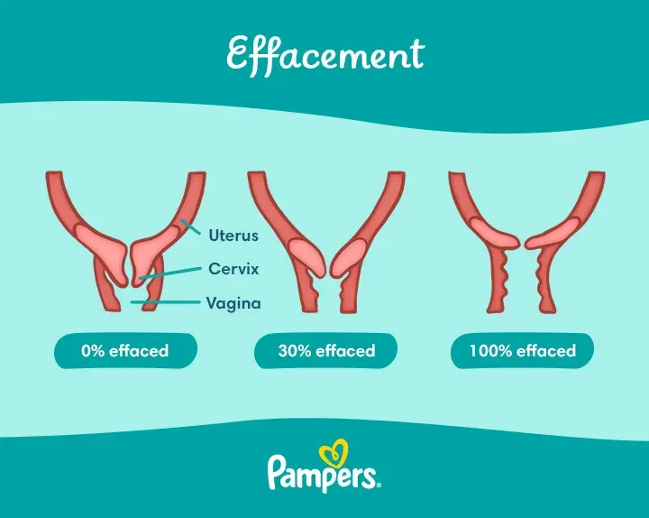 Effacement In Pregnancy What It Means For Labor And Delivery Pampers IN effacement-in-pregnancy-what-it-means-for-labor-and-delivery-pampers-in