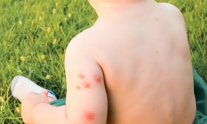 Mosquito Bites on Babies