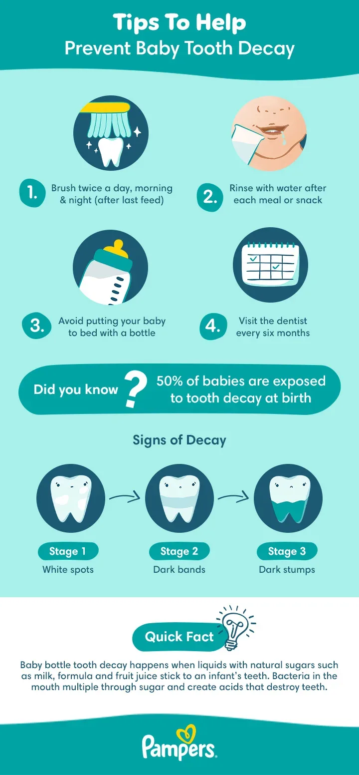 Tips to help prevent baby tooth decay