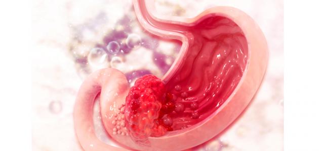  سرطان المعدة... هل بات أكثر شيوعاً بين الشباب؟