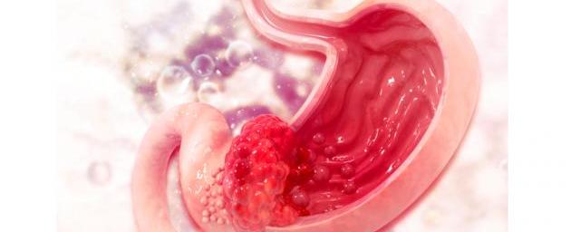 سرطان المعدة... هل بات أكثر شيوعاً بين الشباب؟