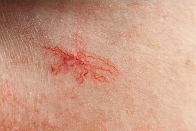 العدو الخفي.. ما أعراض سرطان الخلايا القاعدية الذي يتسلل إلى الجلد؟