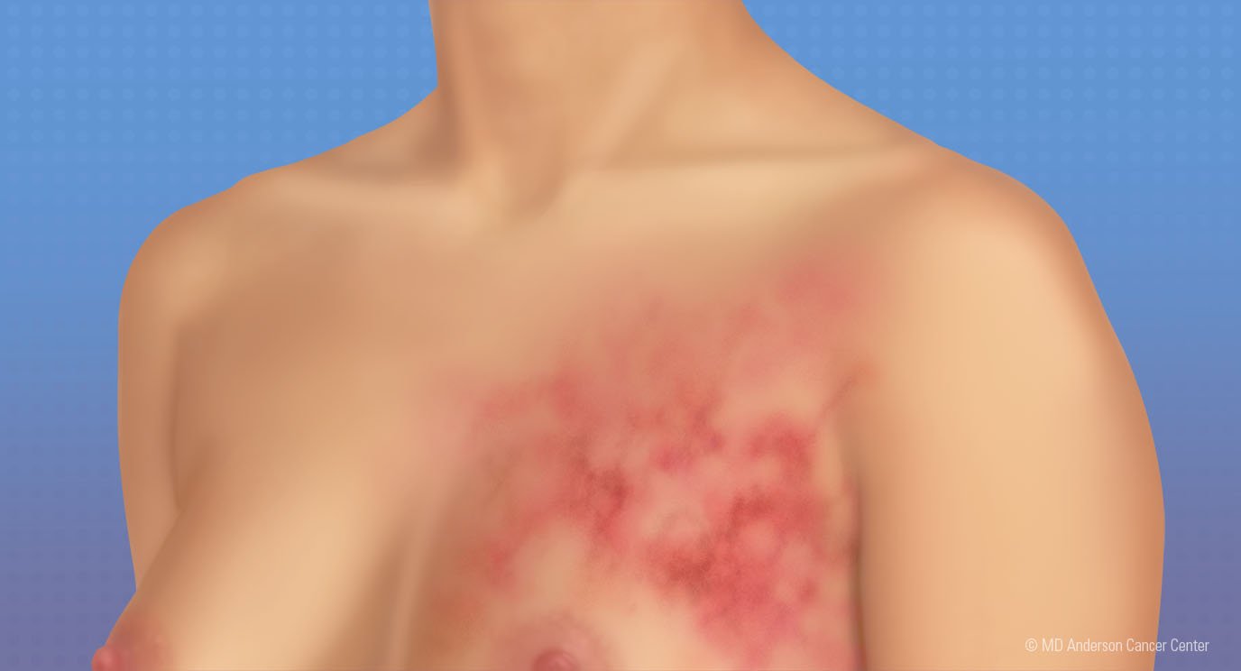  ما هي أولى علامات ظهور سرطان الثدي؟