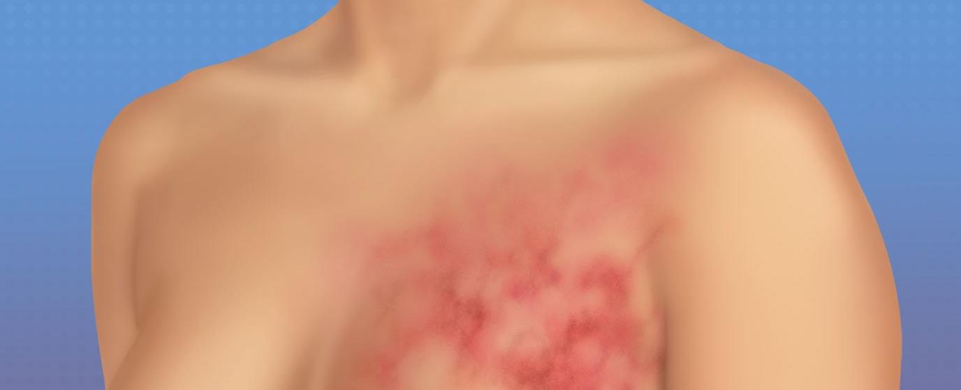 ما هي أولى علامات ظهور سرطان الثدي؟