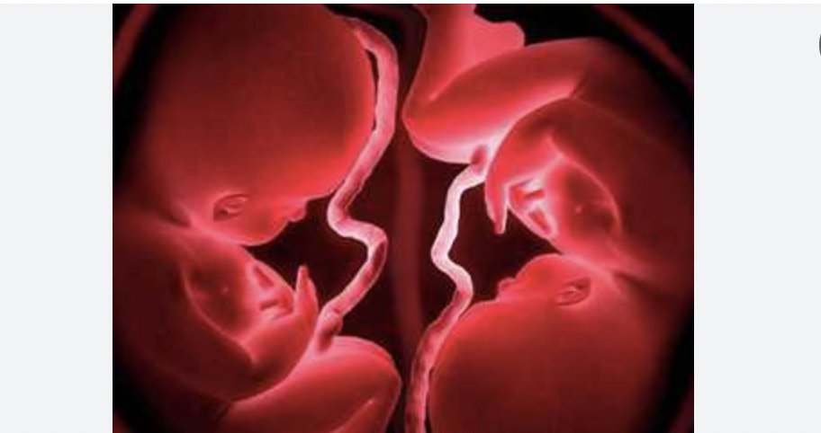 واحد من كل رحم.. في حالة نادرة امرأة بـ"رحمين" تنجب توأمًا 