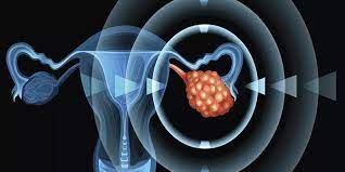 مكافحة سرطان المبيض على خطى لقاح كورونا