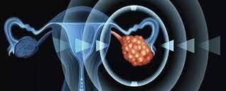 مكافحة سرطان المبيض على خطى لقاح كورونا