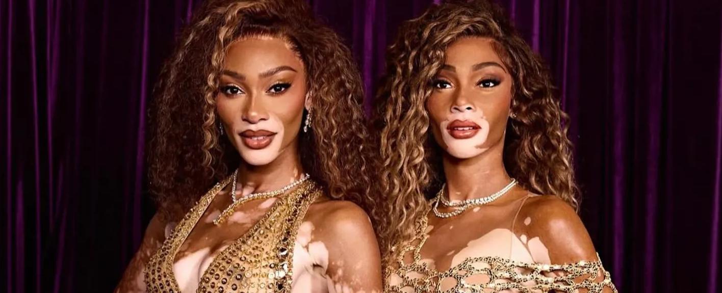 في اليوم العالمي للبهاق.. ويني هارلو بتصميم زهير مراد في متحف مدام توسو