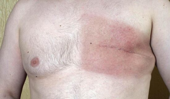 سرطان ثدي الرجال.. أقل شيوعًا وأكثر فتكًا!