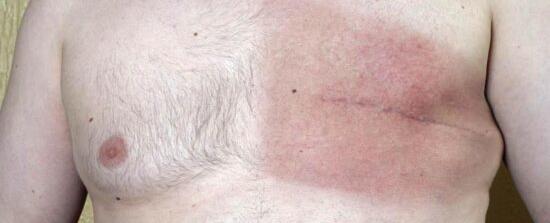 سرطان ثدي الرجال.. أقل شيوعًا وأكثر فتكًا!