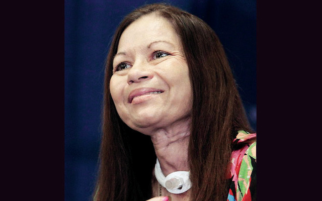 فقدت النطق منذ ٢٣ عامًا.. زرع حنجرة يعيده لفرنسيّة