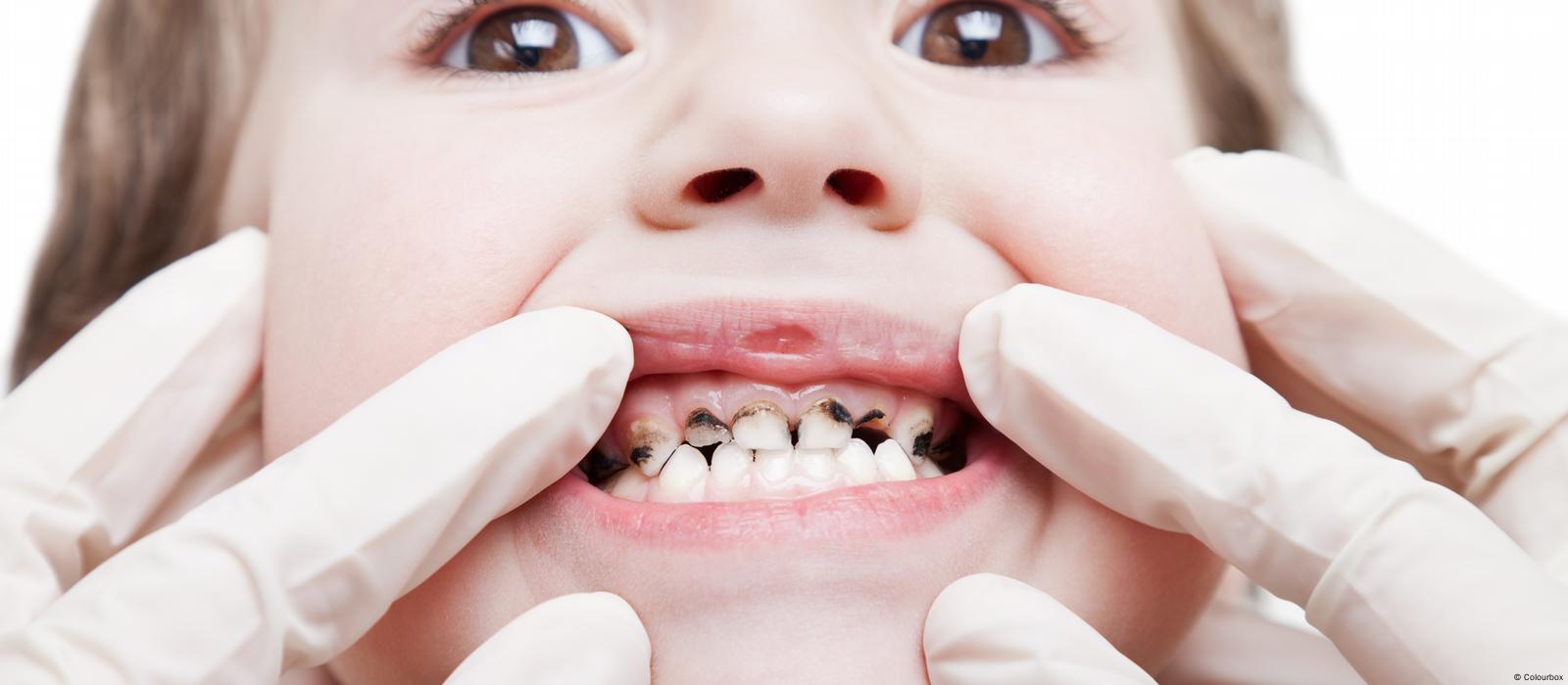 ثورة في طب الأسنان.. لقاح يقي من التسوّس