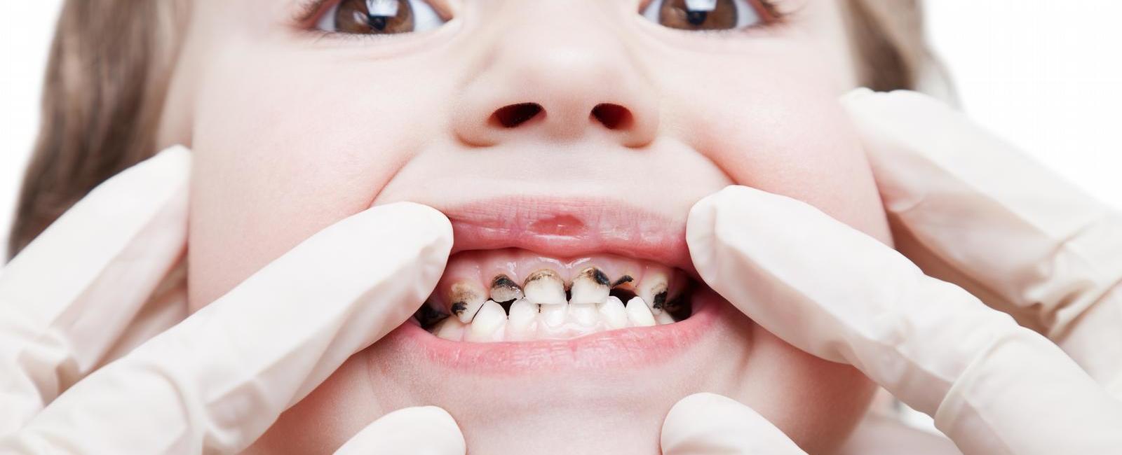 ثورة في طب الأسنان.. لقاح يقي من التسوّس