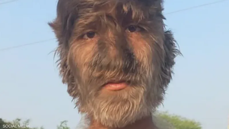 بسبب حالة طبية نادرة.. "مستذئب الهند" يحصد غينيس