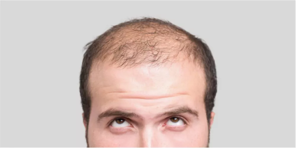 "دواء سحري".. لمعالجة الصلع في 3 أسابيع