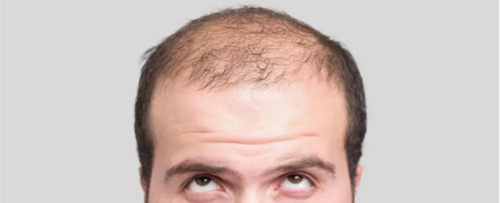 "دواء سحري".. لمعالجة الصلع في 3 أسابيع