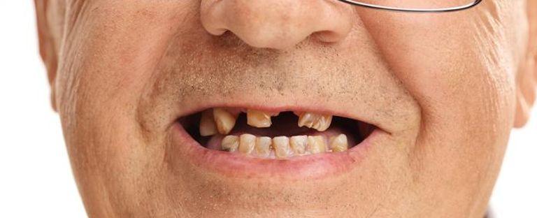 كبار السن وتساقط الأسنان.. 6 طرق فعّالة للوقاية