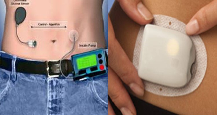 بارقة أمل لمرضى السكري.. البنكرياس الصناعي 
